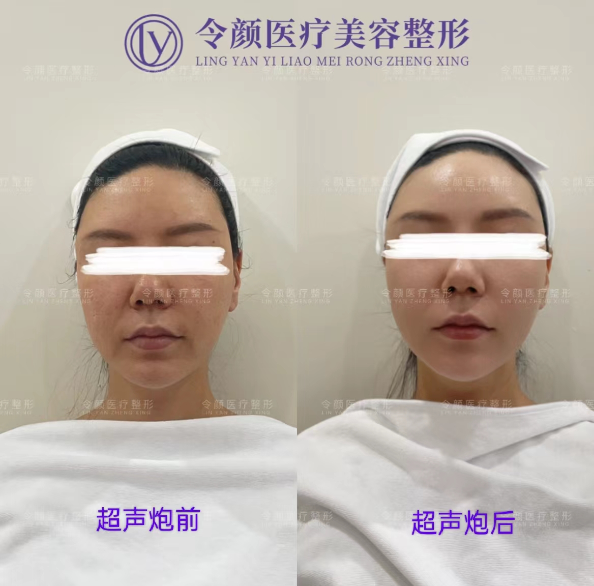 超声炮疗法前后.jpg