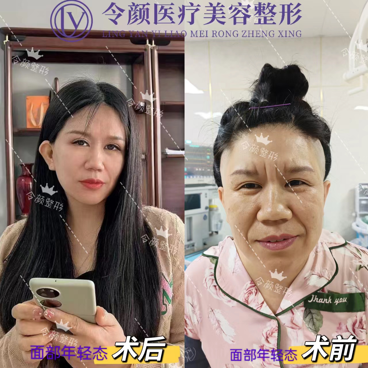 拉皮前后.jpg