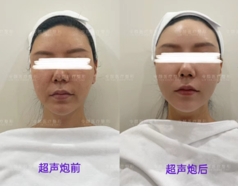 超声炮疗法前后