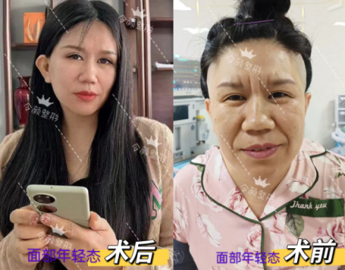 拉皮前后
