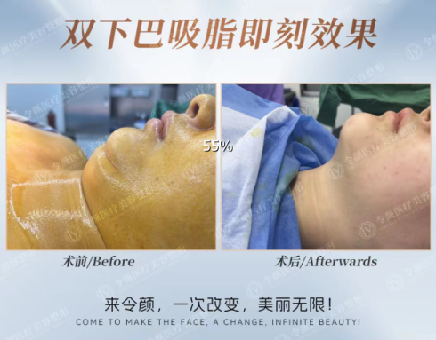 双下巴吸脂